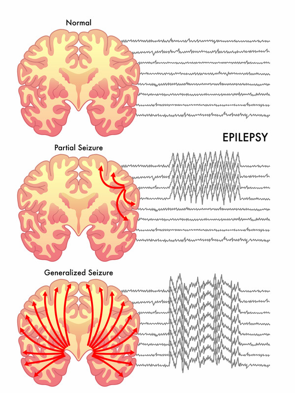 Seizure Overview Harvard Health Seizure Overview Harvard Health