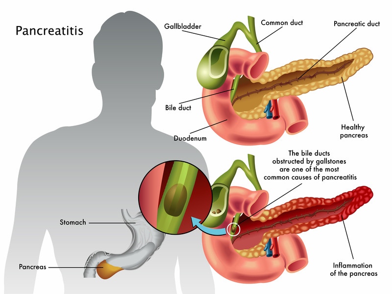 Pancreatitis Guide Causes Symptoms And Treatment Options 3760