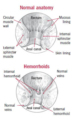 Illustration of normal rectal anatomy and hemorrhoids