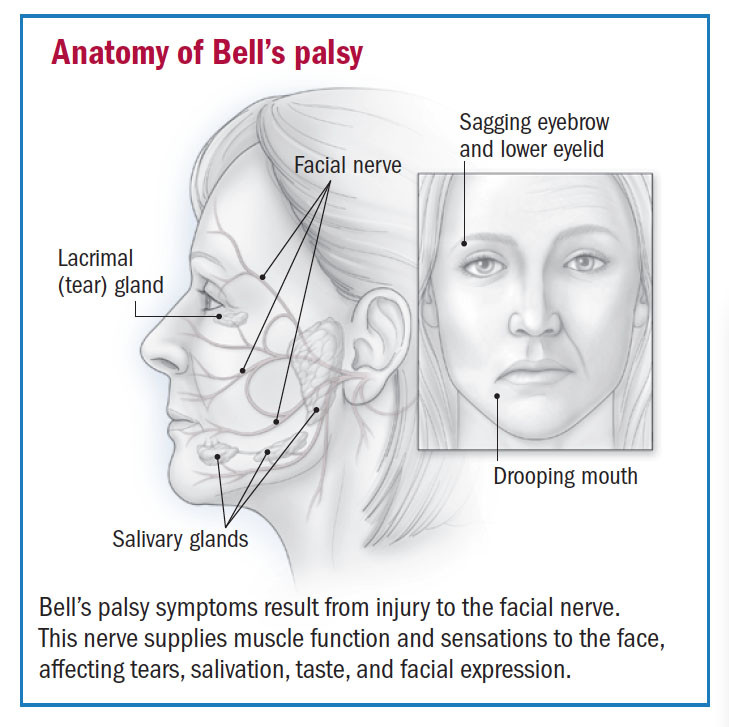 Bell's palsy, also called facial palsy
