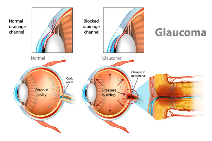 glaucoma eye test