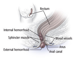 Treatment for external and internal Bleeding hemorrhoids