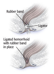 Hemorrhoid rubber band ligation