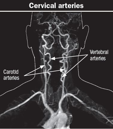Diagram of cervical arteries