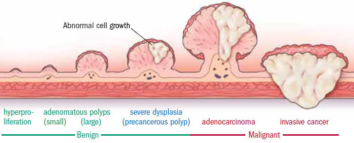 How a colon polyp progresses to cancer