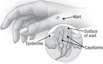 illustration of skin with closeup of wart