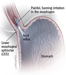 A medical illustration of the stomach and where acid reflux can cause esophagitis.