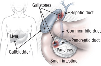 A medical illustration of where in the body gallstones form. 