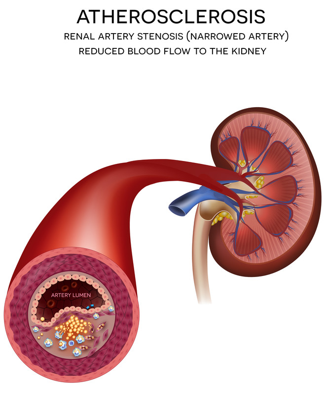 End Stage Renal Disease Harvard Health kidney-failure-symptoms