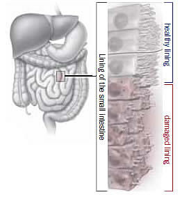 Immune system response to gluten