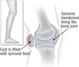 illustration of knee joint showing Baker's cyst