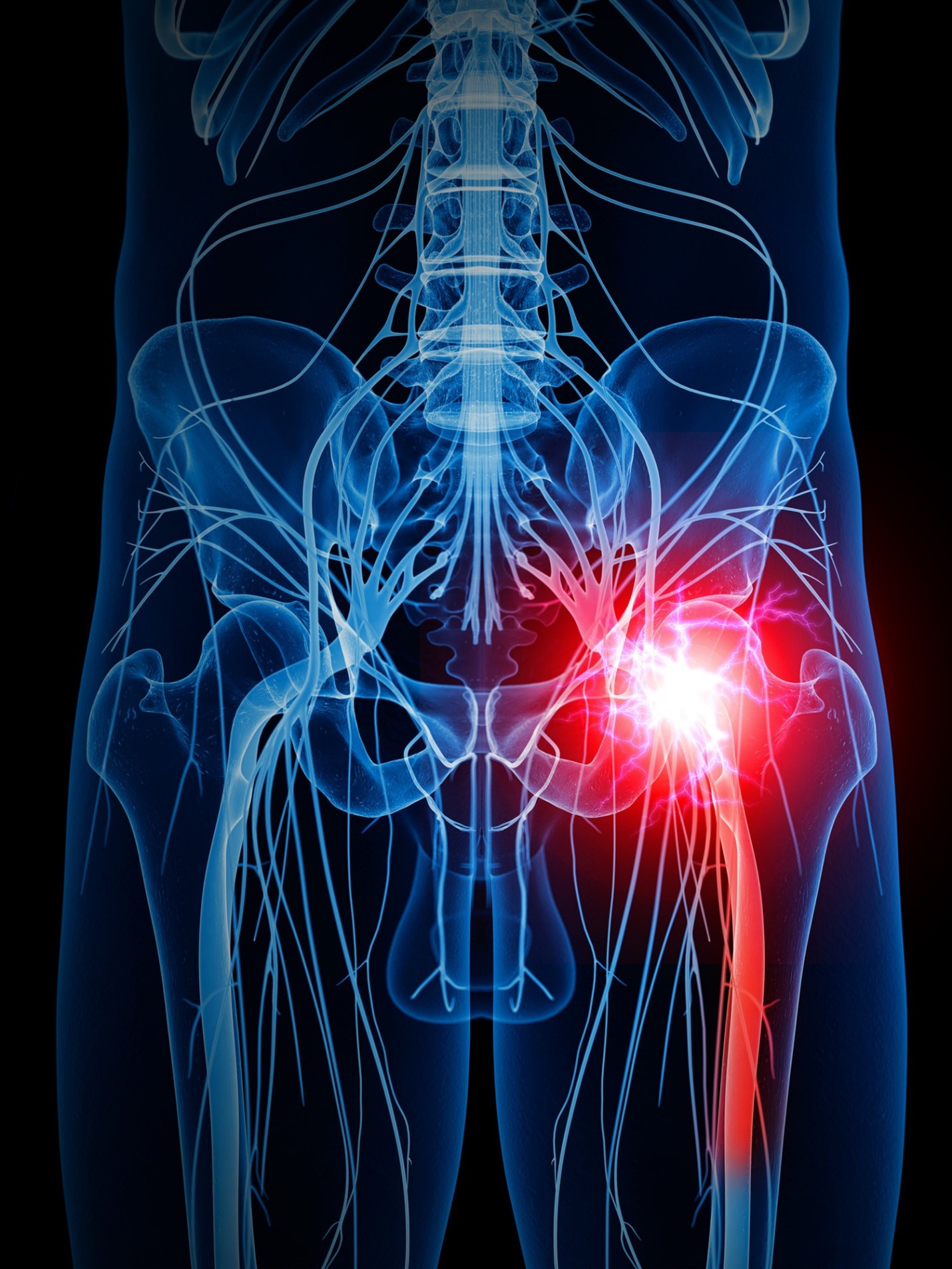 sciatic nerve pain