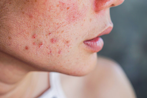 close-up photo of a woman's face showing red irritated areas indicating acne or a rash