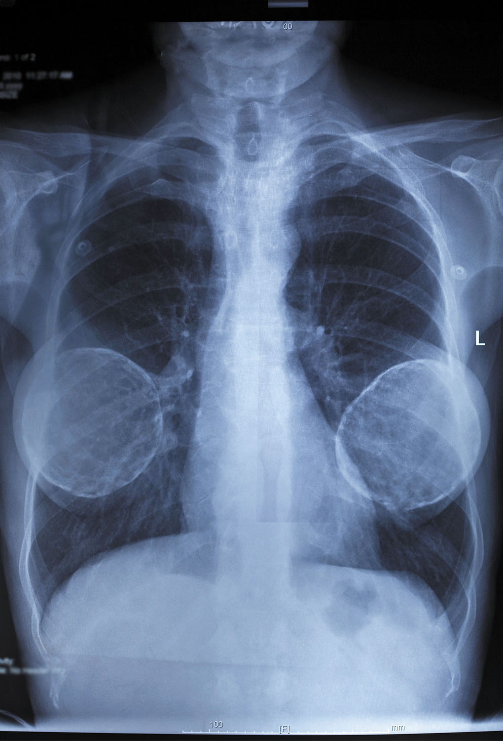 An X-ray of a woman's chest with her breast implants visible. 