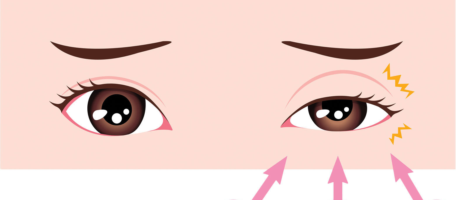 illustration of a pair of eyes with squiggly lines representing twitching of the eyelid