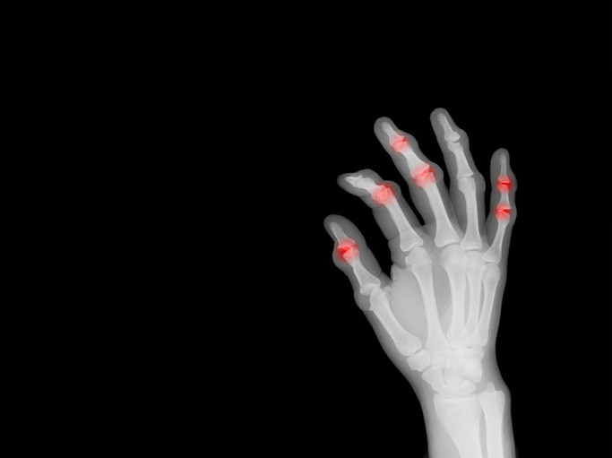 Raio-x em escala de cinza da mão com vários dedos dobrados e áreas avermelhadas mostrando artrite reumatóide contra fundo escuro