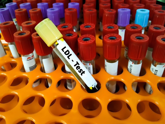 Um rack de plástico laranja com tubos de análise de sangue com tampas de cores diferentes;  topo amarelo no tubo em primeiro plano rotulado "Teste de LDL"