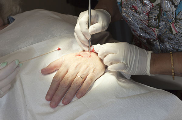 cropped photo of the gloved hands of a surgeon using a scalpel to make an incision on the back of a person's hand, preparing to remove a basal cell cancer