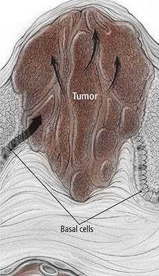 illustration showing how a basal cell carcinoma looks under the skin