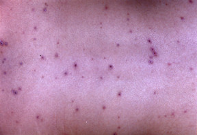 people with chickenpox