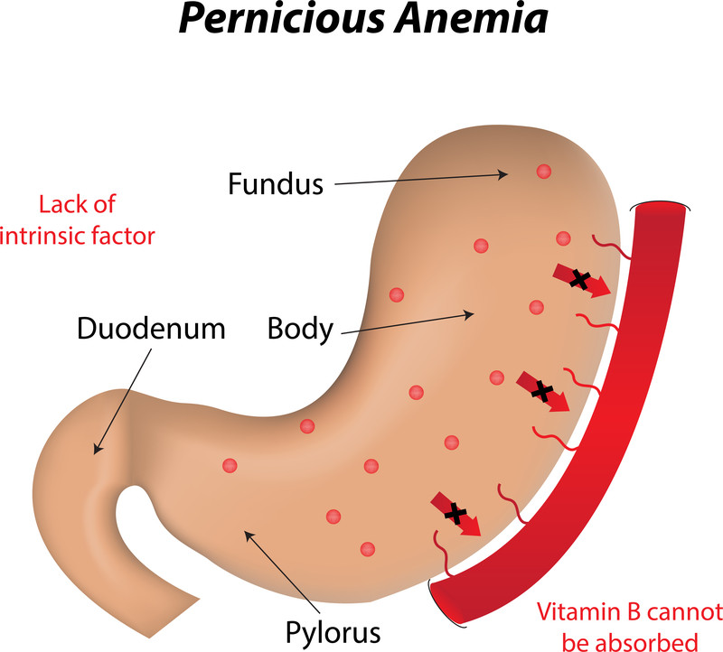 Vitamin B12 Deficiency In Blood Test at Missy Cline blog