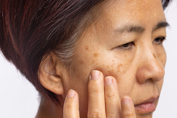 Dark spots on the skin: Causes, treatments, and remedies