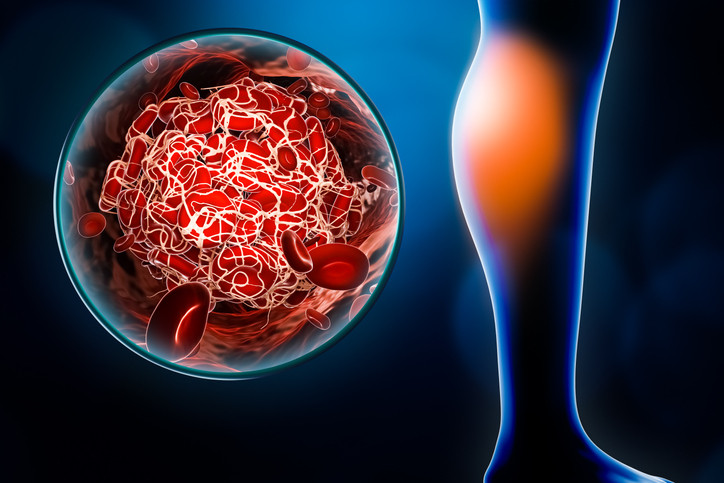 A magnified view that shows a blood clot occurs and where it might occur in blood vessels inside the calf  