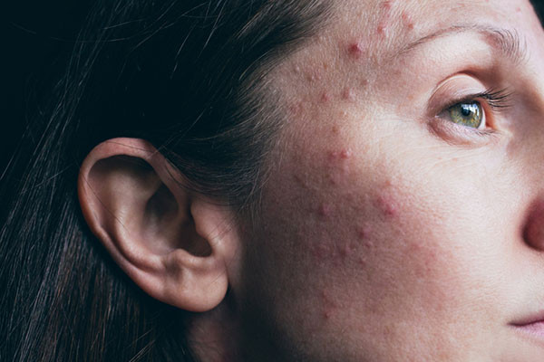 Woke up with a face full of acne? Here are the possible reasons