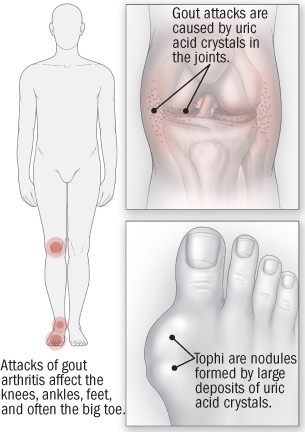 illustration of areas of gout attacks