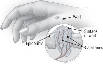 warts on hands treatment