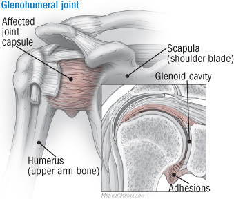 illustration of the shoulder showing the affected joint capsule