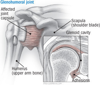 How to release a frozen shoulder - Harvard Health