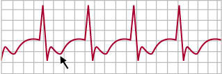 illustration of a heart ECG from a person with non-STEM acute coronary syndrome