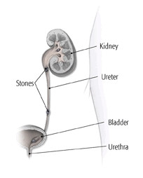 Kidney stones