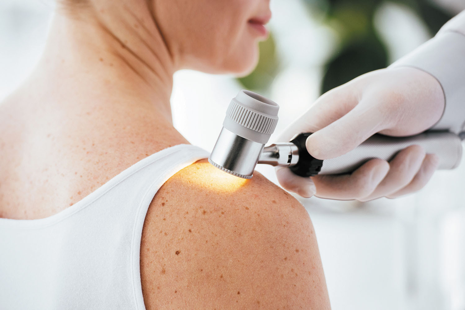 cropped photo showing the shoulder of a woman having her skin examined by a dermatologist