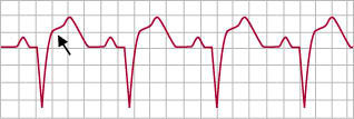 illustration of a heart ECG from a person with ST-segment elevation myocardial infarction (STEM) acute coronary syndrome