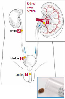 How to prevent kidney stones - Harvard Health