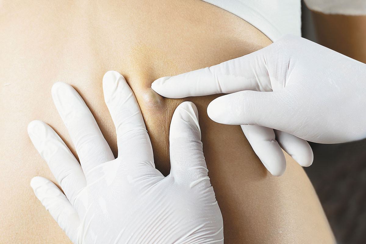 cropped photo of gloved hands examining a bump on a person's upper back