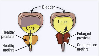 illustration of the condition benign prostatic hyperplasia, showing a healthy prostate and urethra alongisde an enlarged prostate and compressed urethra