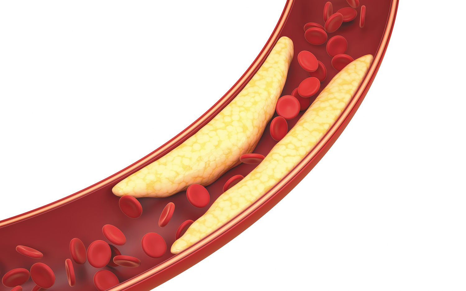 illustration of plaque buildup in an artery