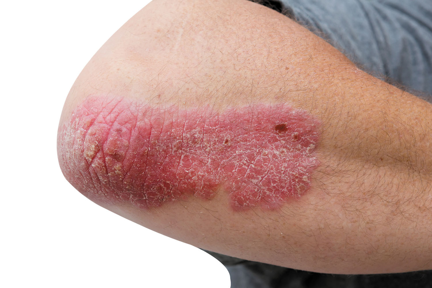 close-up photo of a man's elbow showing a psoriasis outbreak as a red, scaly area
