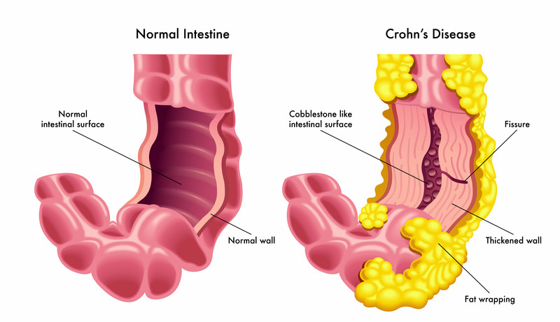 Crohn's Disease - Harvard Health