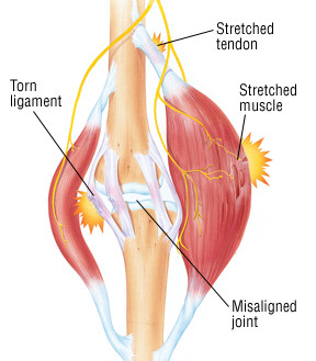 Pulled, Torn Calf Muscle Recovery Time: How to Heal Your Lower Leg