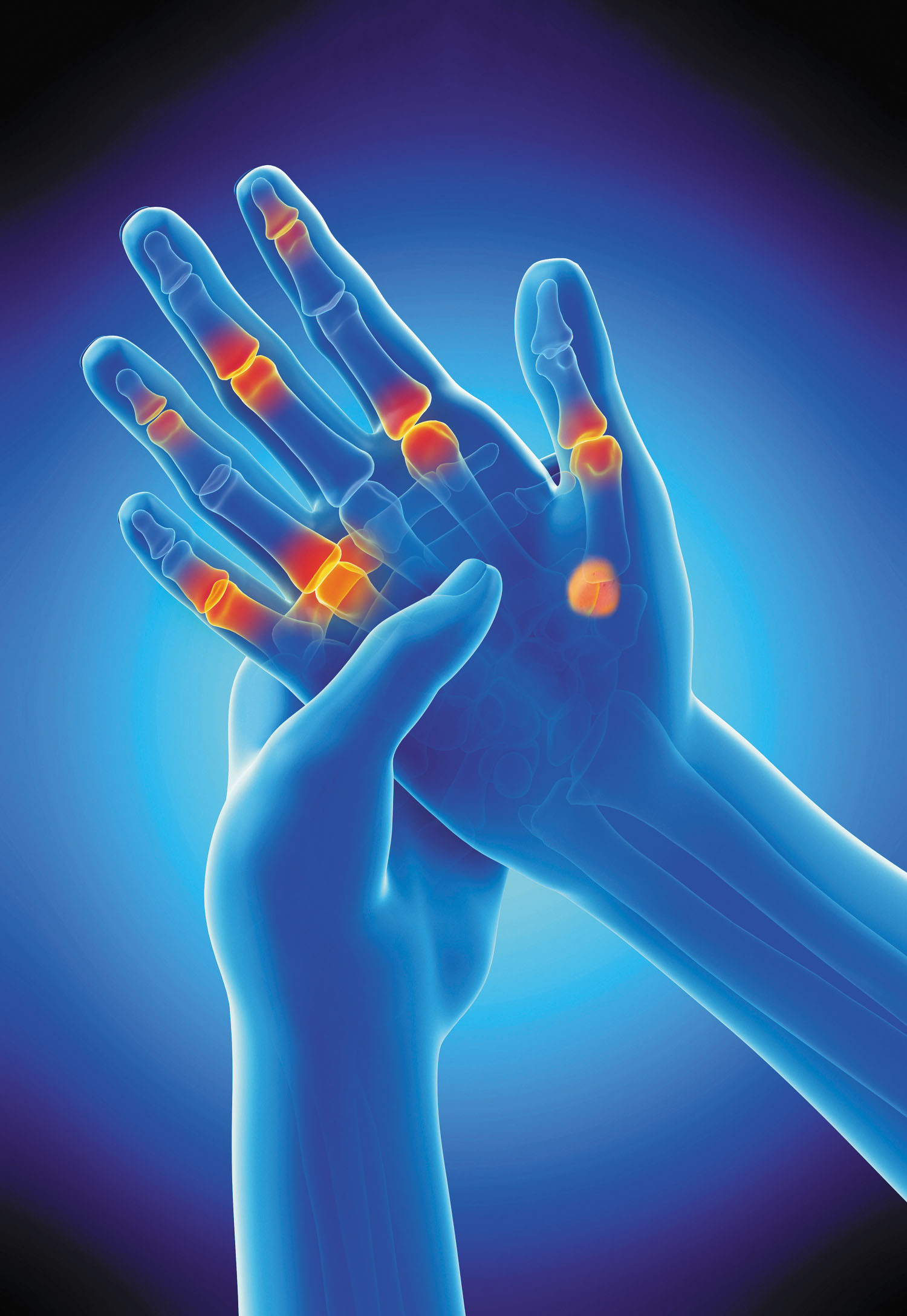 three-dimensional illustration of a hand in blue showing pain spots in the joints as orange