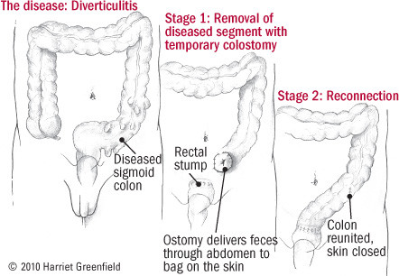 illustration of surgical procedure for diverticulitis
