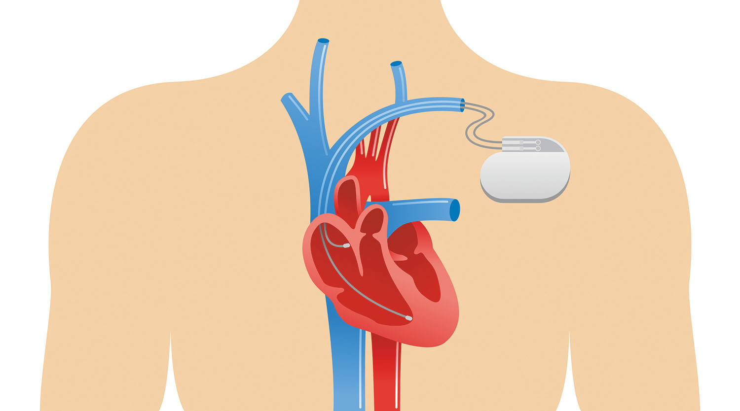 illustration showing placement of a pacemaker in a human body and how it is connected to the heart