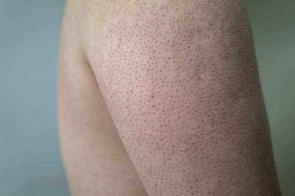 cropped photo showing a close-up view of the upper arm of a person with keratosis pilaris; the skin is covered with small red bumps as described in the article