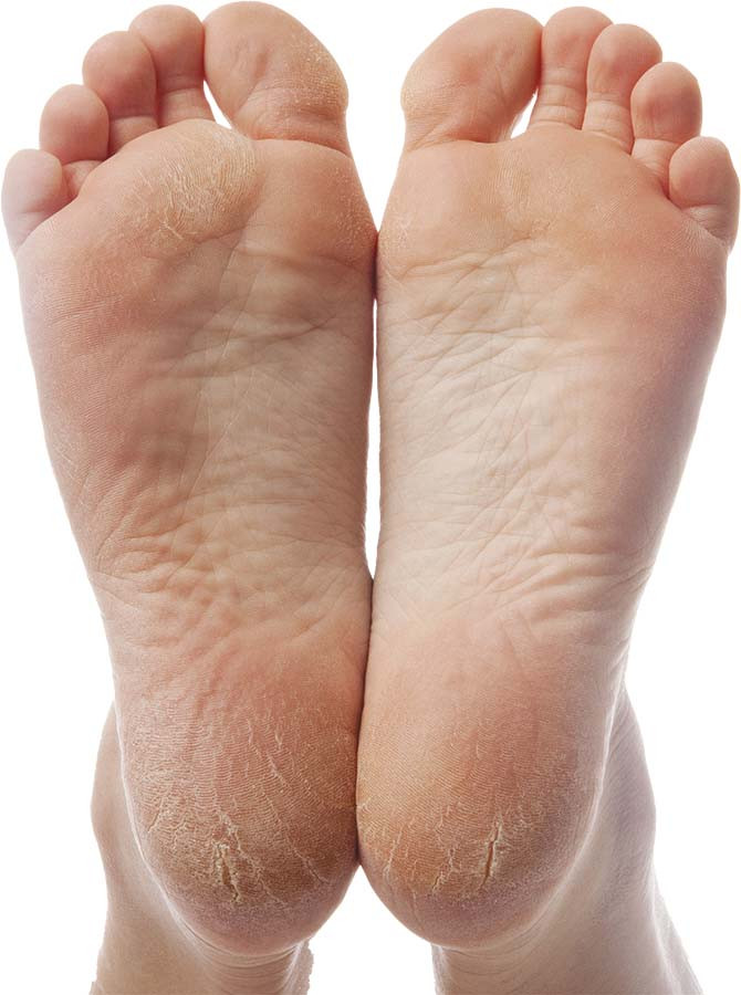 photo of the bottoms of a pair of feet showing cracked skin