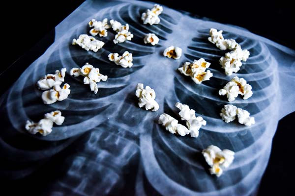 photo of pieces of popcorn on an x-ray printout of a human rib cage to depict the concept of the medical condition bronchiolitis obliterans, better known as popcorn lung