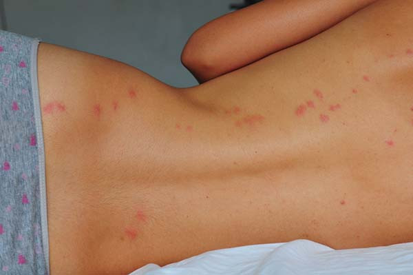 photo of a woman on her side with her back to the camera, showing red bites from bed bugs